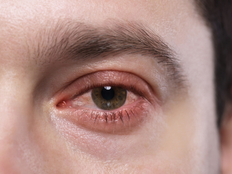 🤦‍♂️ ¿La crema de tus ojos puede curar la conjuntivitis? ¡O sí...