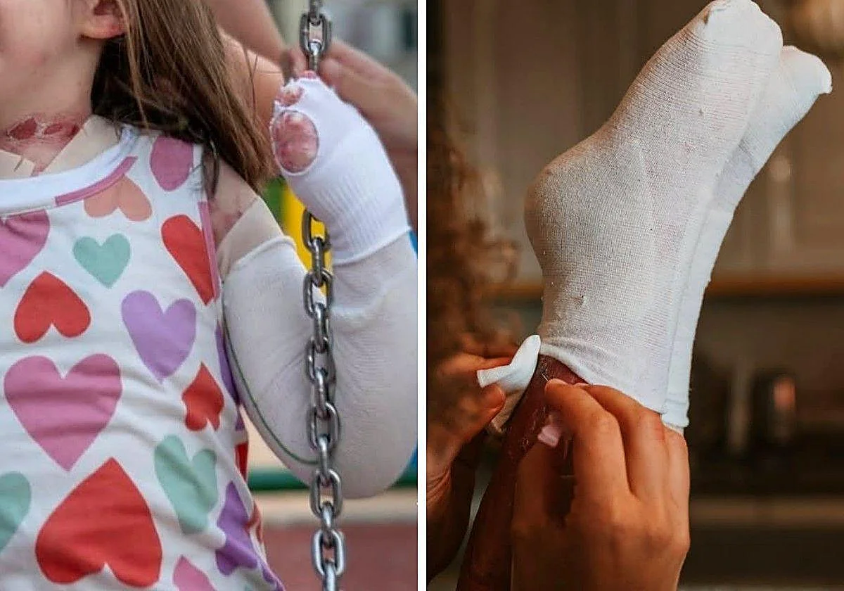 Esto es oro: ¿Cuántos casos de piel de mariposa hay en Ext...